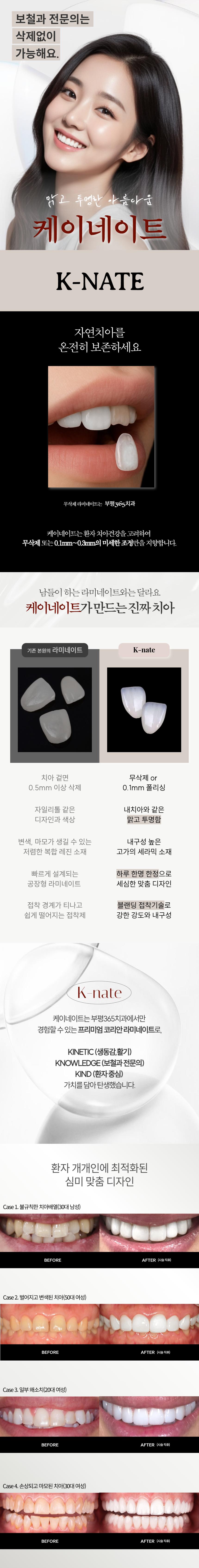 케이네이트는 하루 단 한사람을 위해 집중 제작합니다.
또한 환자 치아건강을 고려하여 무삭제 또는 0.1mm~0.3mm의 미세 조정만을 지향합니다.

자연치아를 보존하고 이쁜 미소를 원하시는 분은 케이네이트하세요.