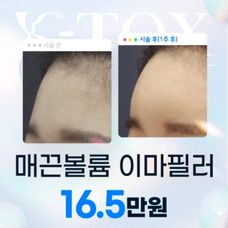 매끈볼륨 전체이마필러 