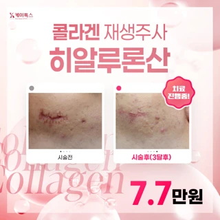 콜라겐재생주사 히알루론산