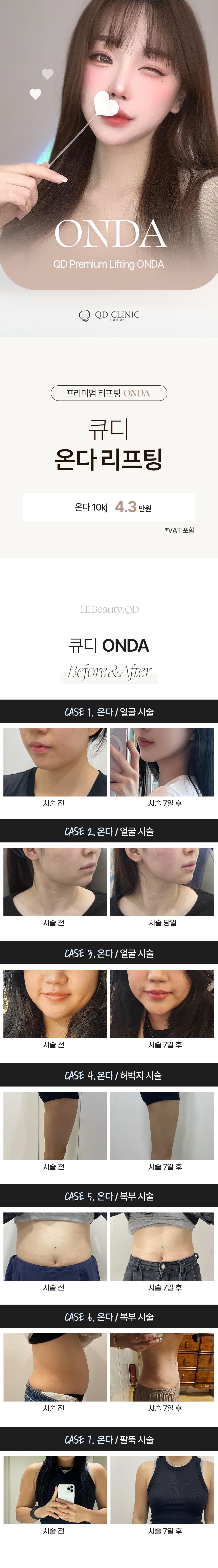 온다리프팅 원리
온다 리프팅은 고주파(RF), 초음프(HIFU)를 대신하는 극초단파(Microwave)를 사용하는 시술로3mm 및 7mm의 핸드피스로 에너지의 80%까지 피부 진피층의 지방에 침투 깊이를 조절하여 최적화된 효과를 볼 수 있습니다. 지속적인 쿨링과 온도 센서를 통해 피부를 보호하며 피부 진피층까지 타이트닝 및 콜라겐 리모델링을 합니다. 


온다리프팅 효과
1. 지속적인 콜라겐 리모델링
2. 리프팅, 타이트닝 효과
3. 피부결 개선
4. 이중턱 개선 
4. 피부 탄력 증진

병원의 특별함
- 프라이빗한 1인실
- 1:1 맞춤 원장님 상담 
- 저희가 클렌징 직접 해드립니다.
- 마크뷰 3D 피부진단
- 직장인을 위한 화,목요일 야간진료
- 시술 후 진정관리 
