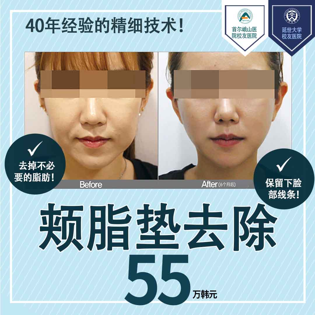 颊脂垫去除清潭/狎鸥亭/新沙推荐医院和价格比较(2026) | 康南医美