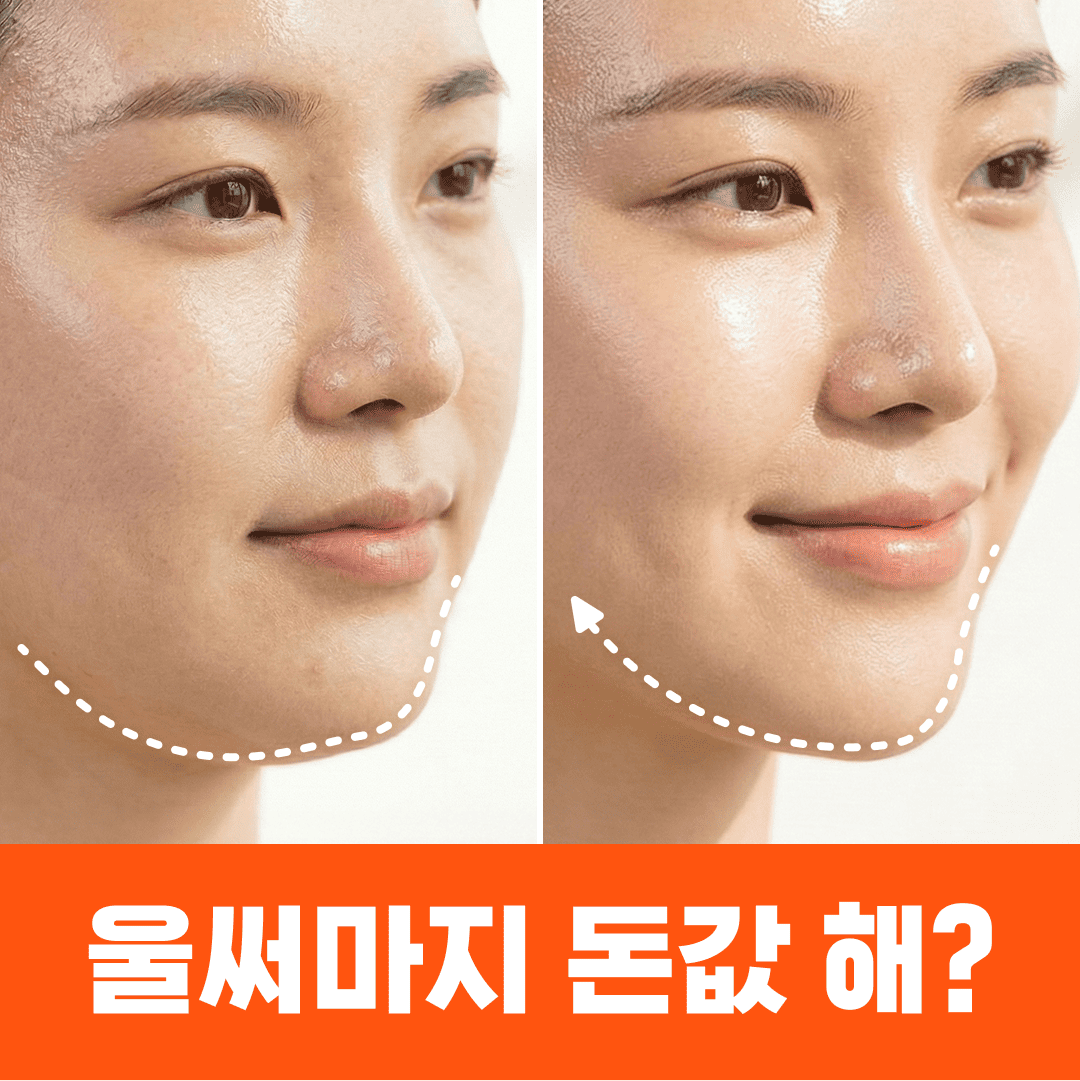 울쎄라 써마지 리프팅 비포애프터