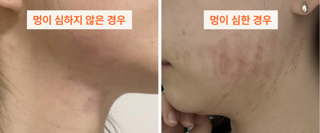 인모드 리프팅 멍