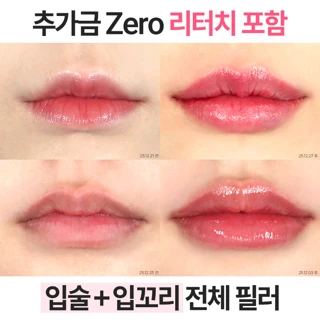 입술 입꼬리 전체 필러