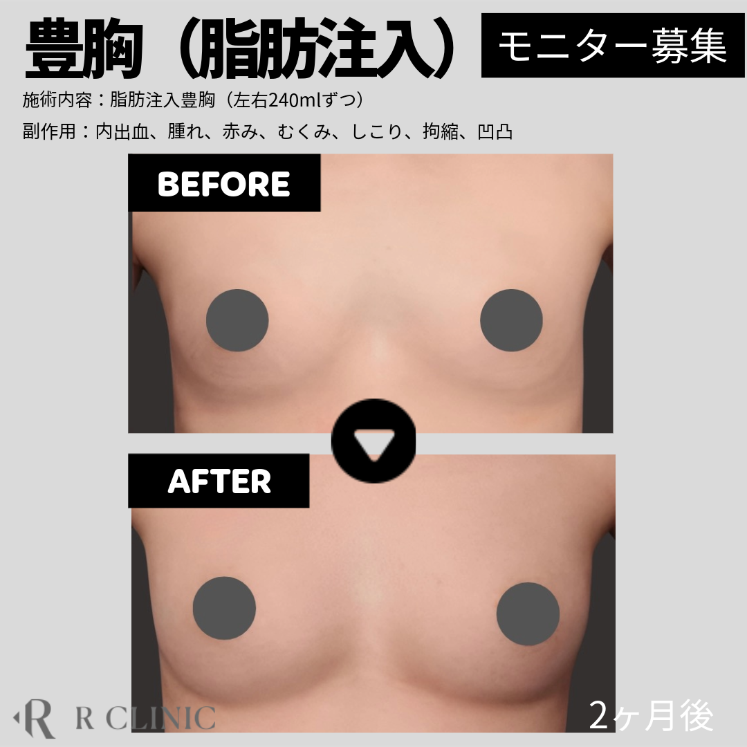 バストアップ+豊胸 レビューの多い順 おすすめクリニック・値段の比較