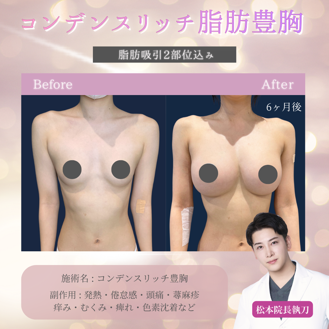 バストアップ+豊胸 レビューの多い順 おすすめクリニック・値段の比較