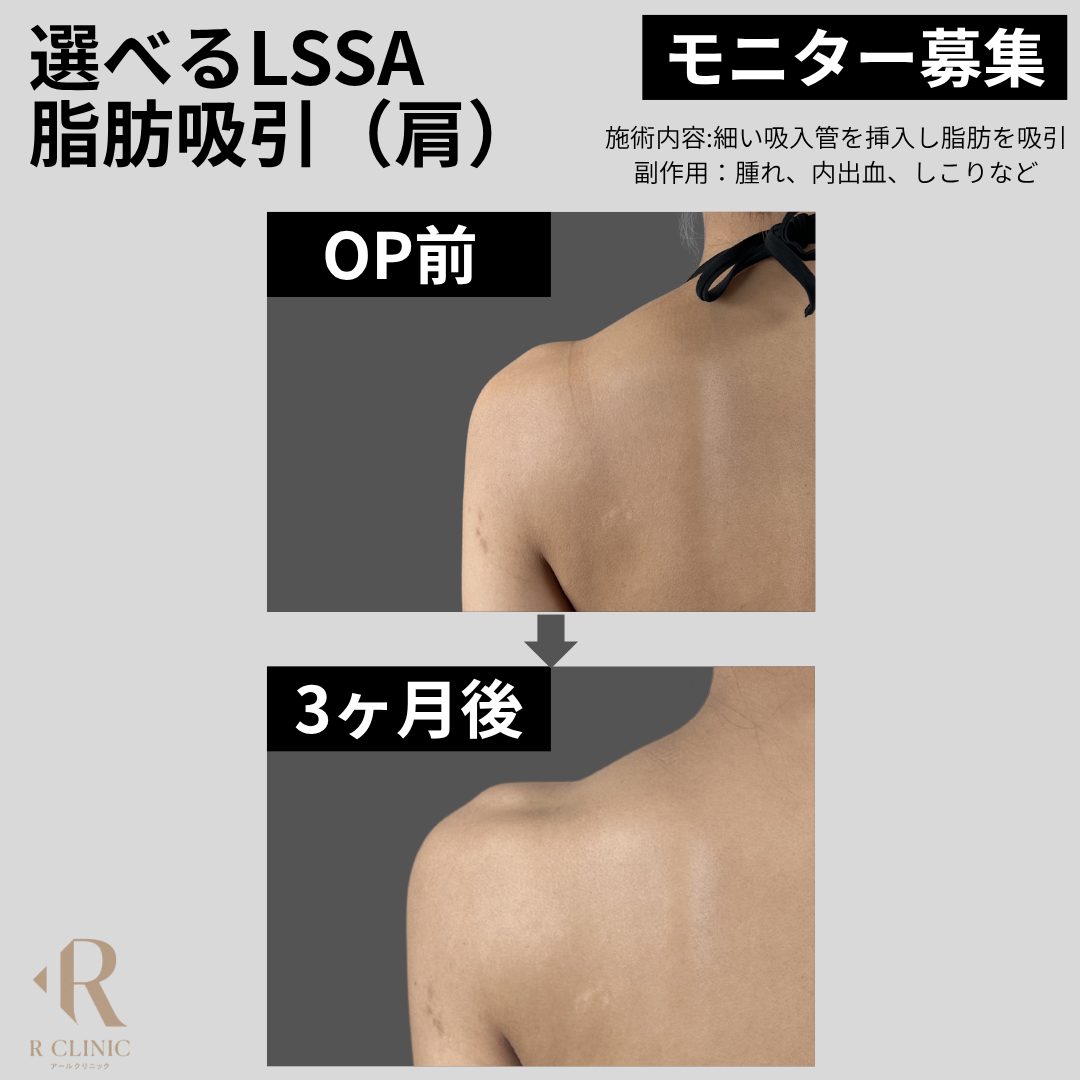 新宿 腹部脂肪吸引おすすめ 新着順 おすすめクリニック・値段の比較