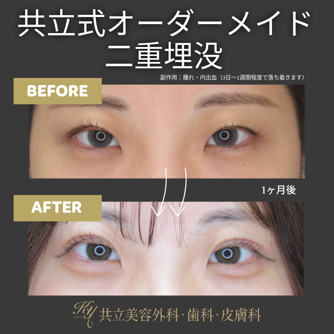 6名限定】腫れにくい・バレない｜共立式オーダーメイド二重埋没＜追加