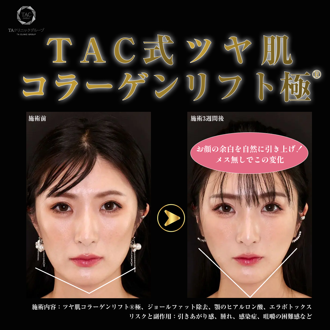全顔モニター】糸リフト（スレッドリフト）4本｜麻酔込｜1年保証｜独自