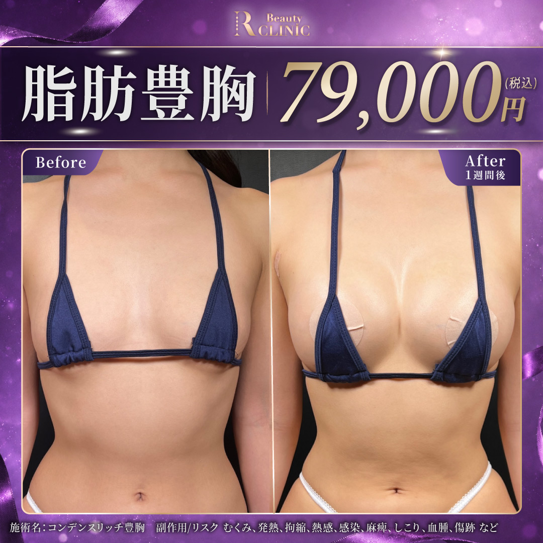 豊胸(脂肪注入) 割引率の高い順 おすすめクリニック・値段の比較(2026