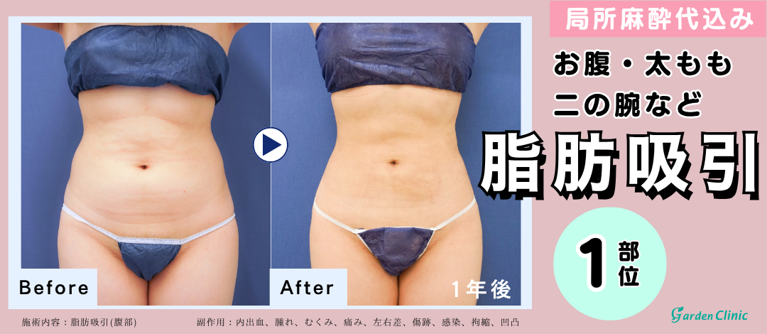 モニター】3名様限定！選べる脂肪吸引｜身体の気になる部位に｜1部位
