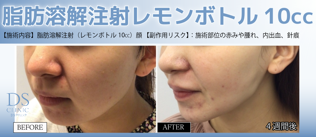 部位選択可】脂肪溶解注射（レモンボトル10cc）｜顔・腕・お腹など気に