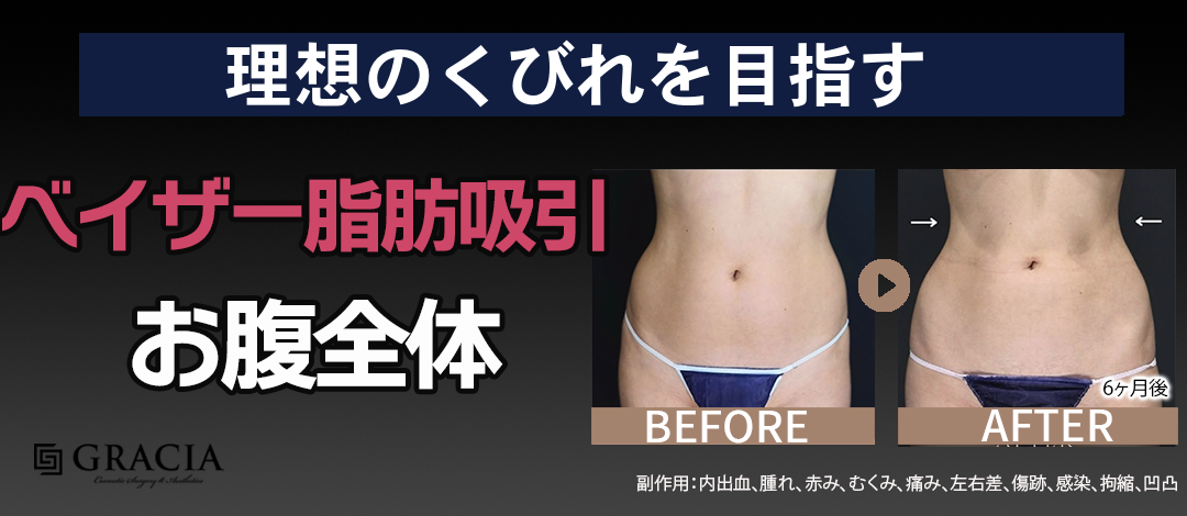 ベイザー脂肪吸引お腹全体／ポッコリお腹にサヨナラ／解剖学を熟知した