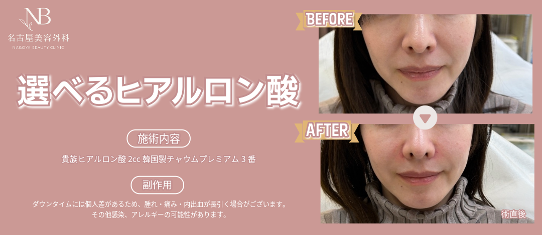 何度でもOK】選べるヒアルロン酸1cc｜ニューラミス・アラガン