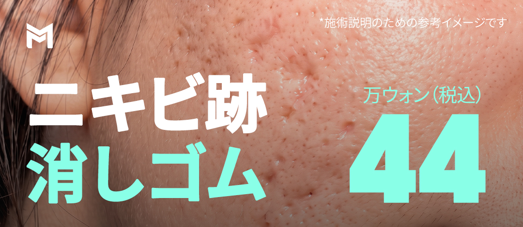 ニキビ跡改善_MIRAJET＆ジュベルックボリューム_クレーター状ニキビ跡_