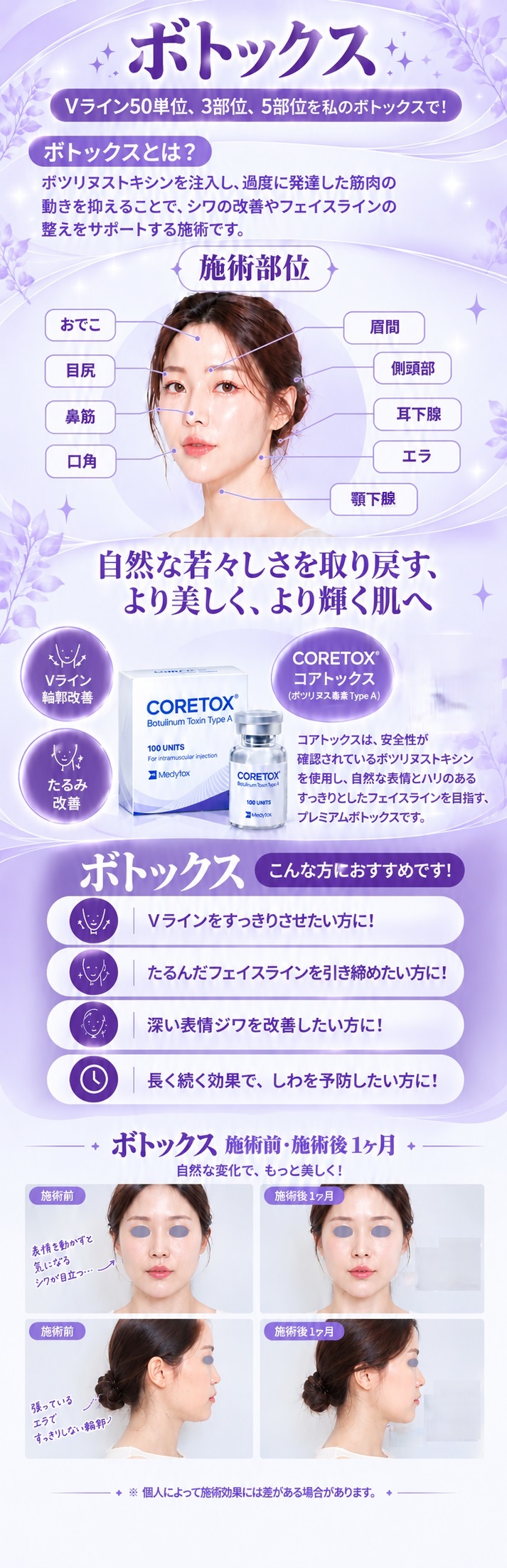 ボトックス＿コアトックスVライン50単位＆3部位,5部位選択 | WIZ&MI医院