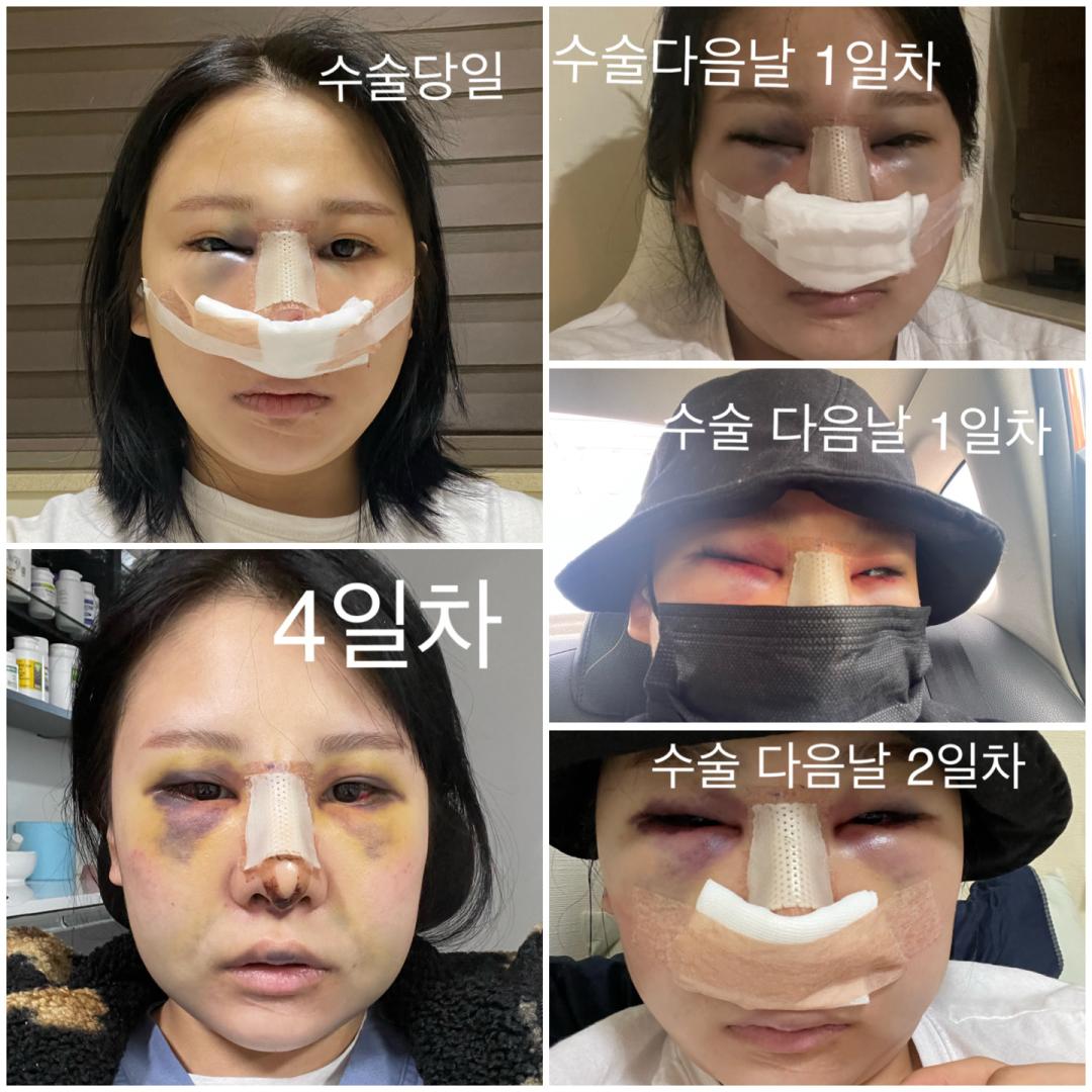 자유수다: #ㄱㄹ성형외과#코수... | 강남언니 - 1등 성형수술&피부시술 정보앱