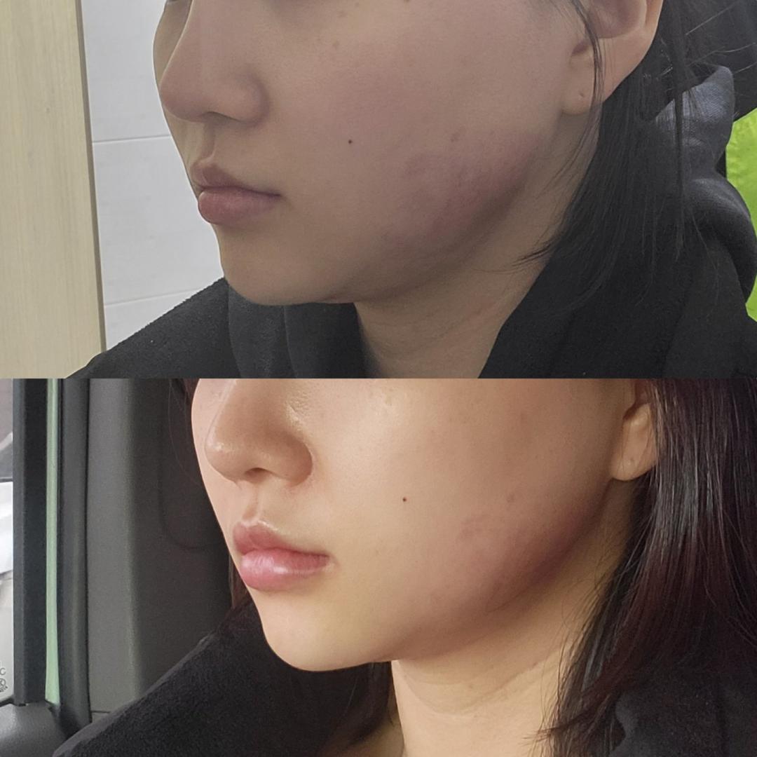 시술/수술 질문: 오늘 인모드랑 턱필... | 강남언니 - 1등 성형수술&피부시술 정보앱