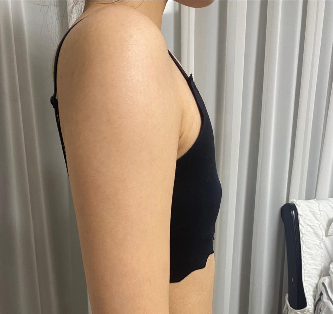 자유수다: 진짜 마른체형도 가... | 강남언니 - 1등 성형수술&피부시술 정보앱