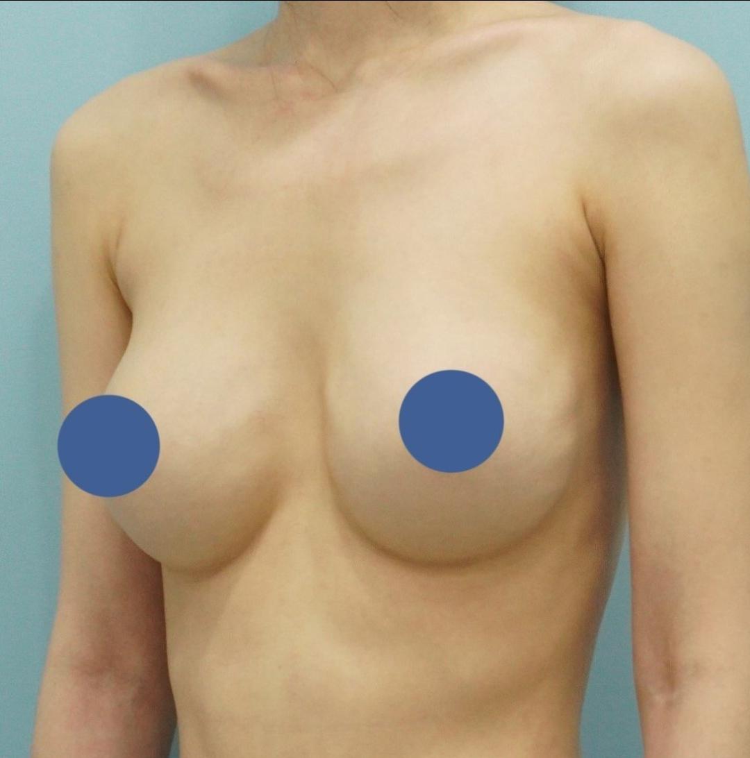 자유수다: 리플링때문에 가슴재... | 강남언니 - 1등 성형수술&피부시술 정보앱