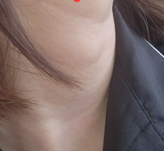 before photo: イオン導入