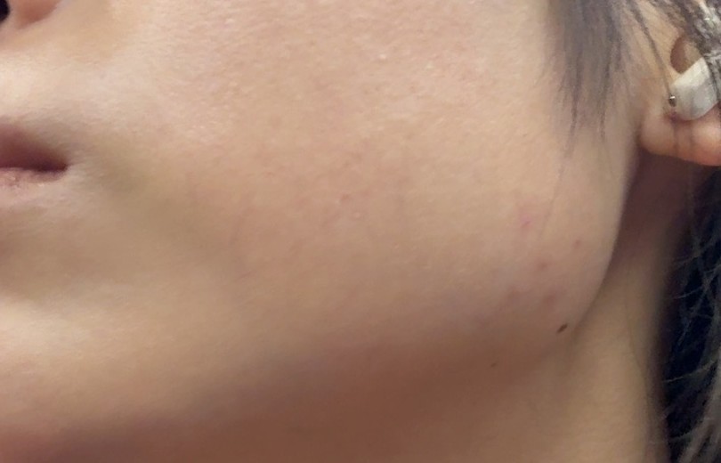 after photo: エラボトックス