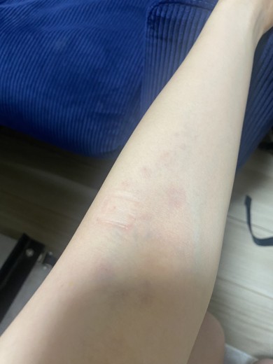 after photo: 白玉注射・点滴
