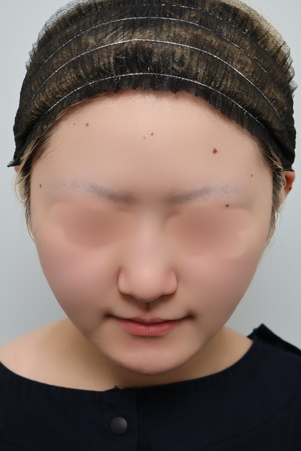 Ｃ【初手術限定】鼻先肋軟骨-ｵﾌﾟｼｮﾝから麻酔まで込々〖定額プラン〗 | BIKAN整形外科, image size:960x1440