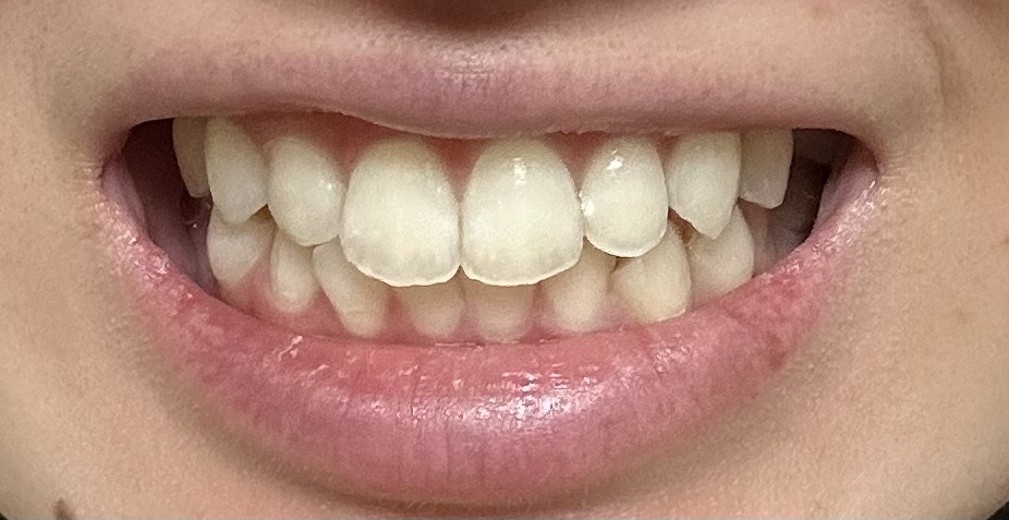 after photo: ホワイトニング