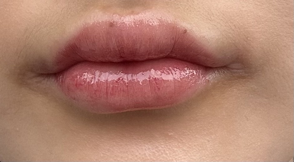 after photo: 입꼬리필러, 입술필러