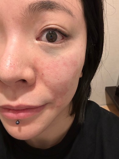 after photo: ジュベルック(Juvelook)