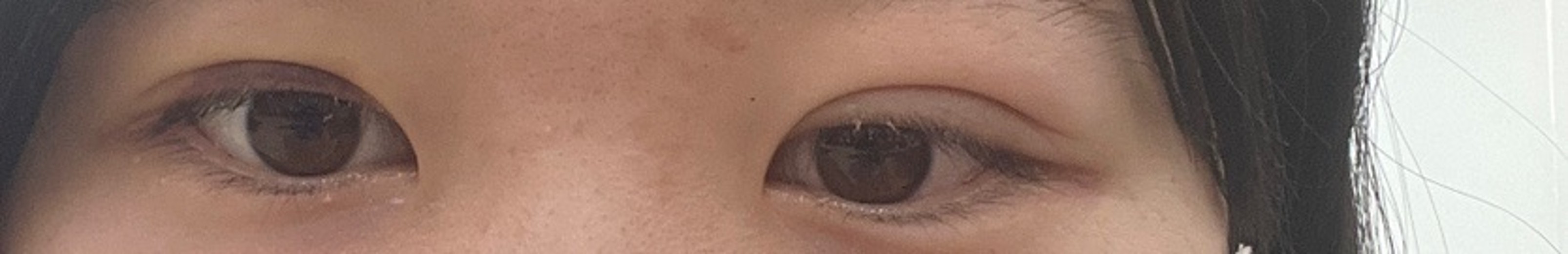 after photo: 二重(埋没)