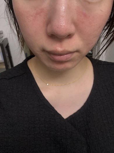 after photo: ダーマペン