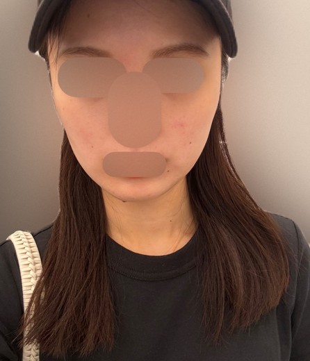 after photo: リニアファーム(ハイフ)
