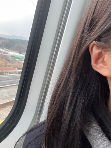 after photo: 캘로이드귀성형