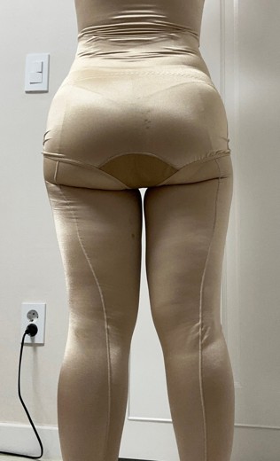 after photo: 전신지방흡입