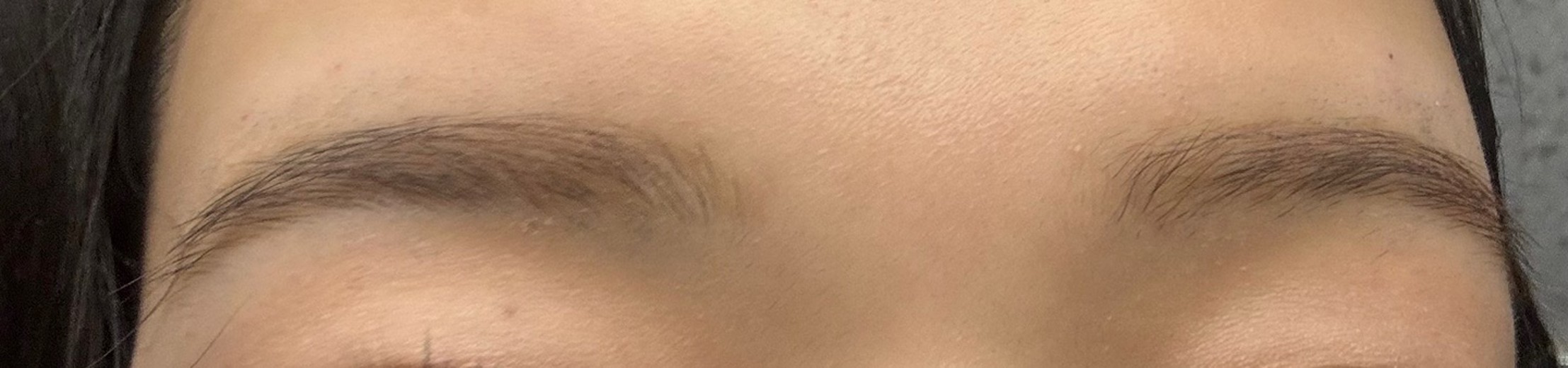 after photo: 額のしわボトックス