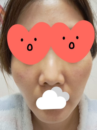 after photo: ピーリング, エレクトロポレーション, ルメッカ