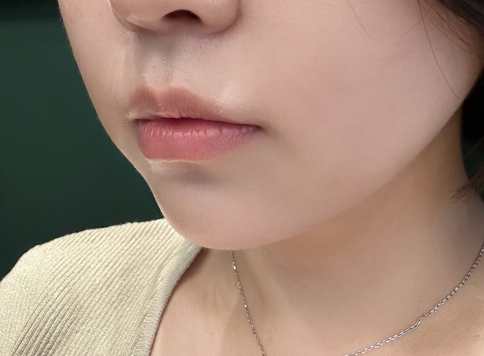 before photo: 입꼬리필러, 입술필러