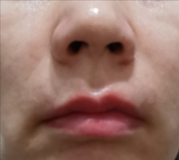 after photo: 脂肪溶解注射(顔)