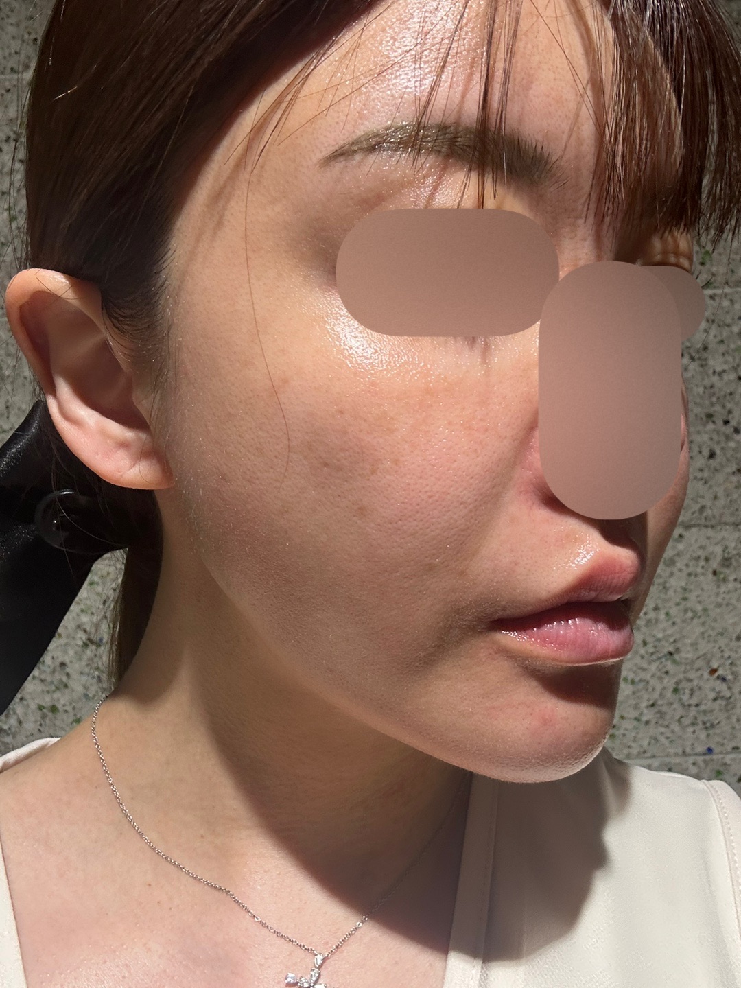 フォトフェイシャル ステラM22（全顔） | mywclinic〔ミュー