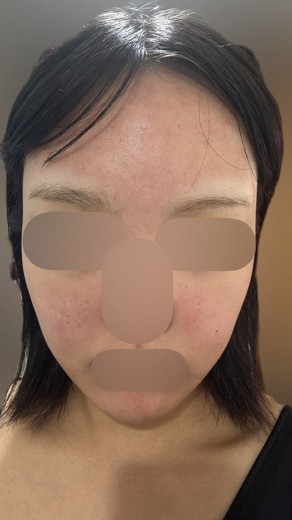 after photo: ダーマペン
