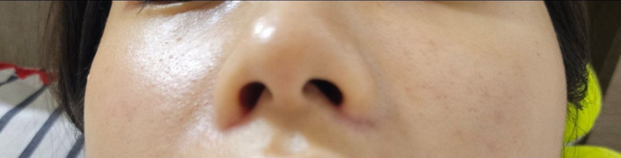 after photo: 콧볼축소