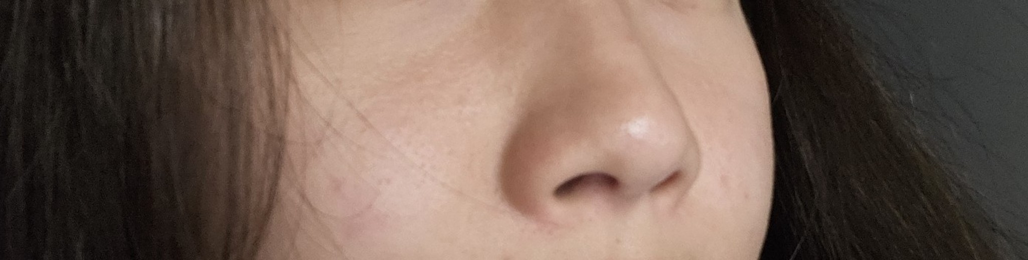 before photo: 콧볼축소