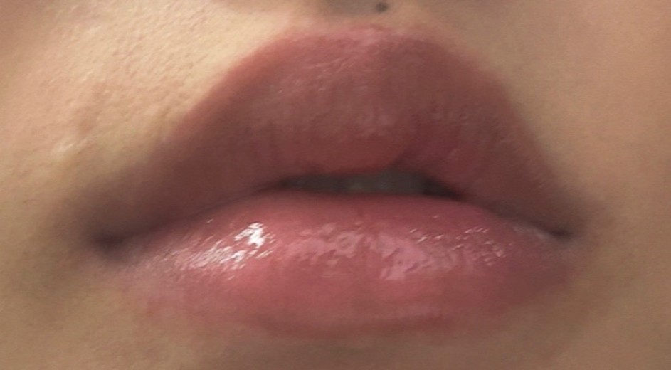 after photo: 입술필러
