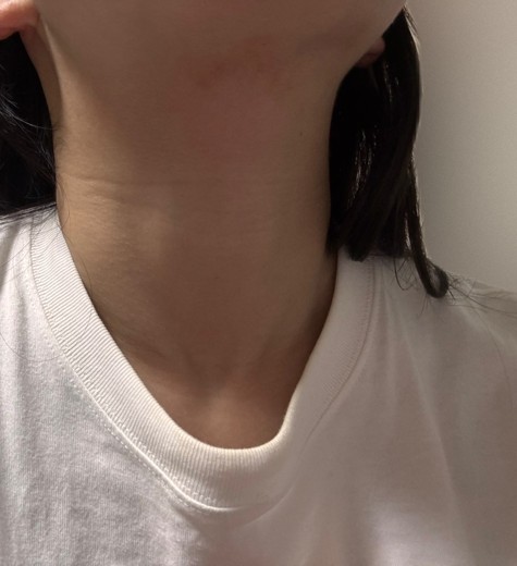 after photo: インモード