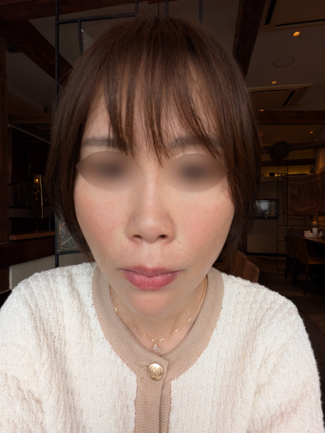 目尻・目の下ボトックス注射｜ボツリヌストキシン注射（1部位）｜目尻のシワ｜1カ月保証 | 横浜TAクリニック, image size:1080x1440