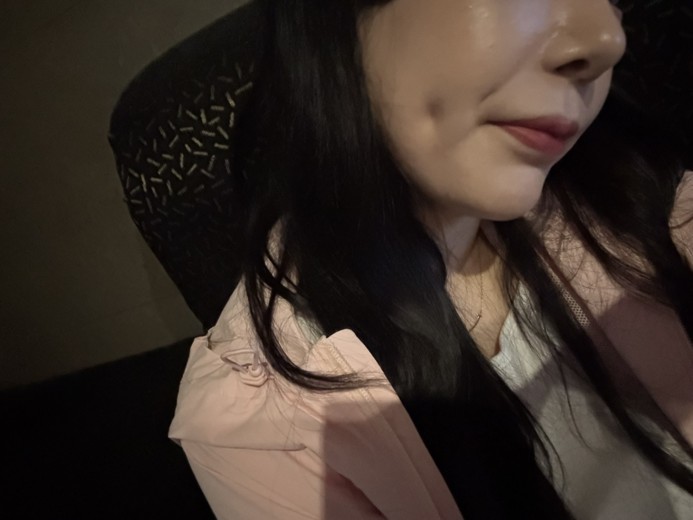 after photo: 보조개성형