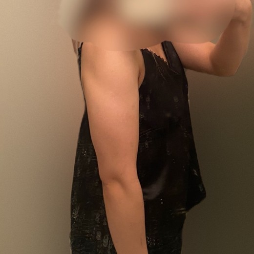 before photo: 脂肪溶解注射(腕), 脂肪溶解注射(太もも)