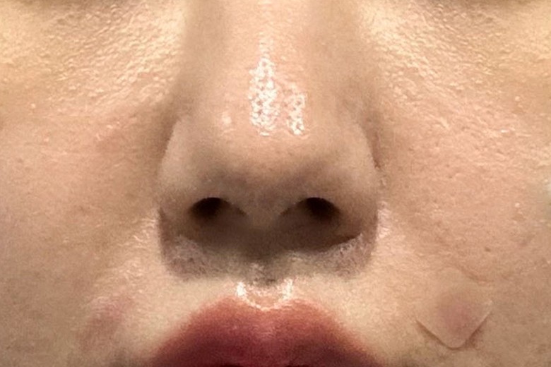 before photo: 피코토닝